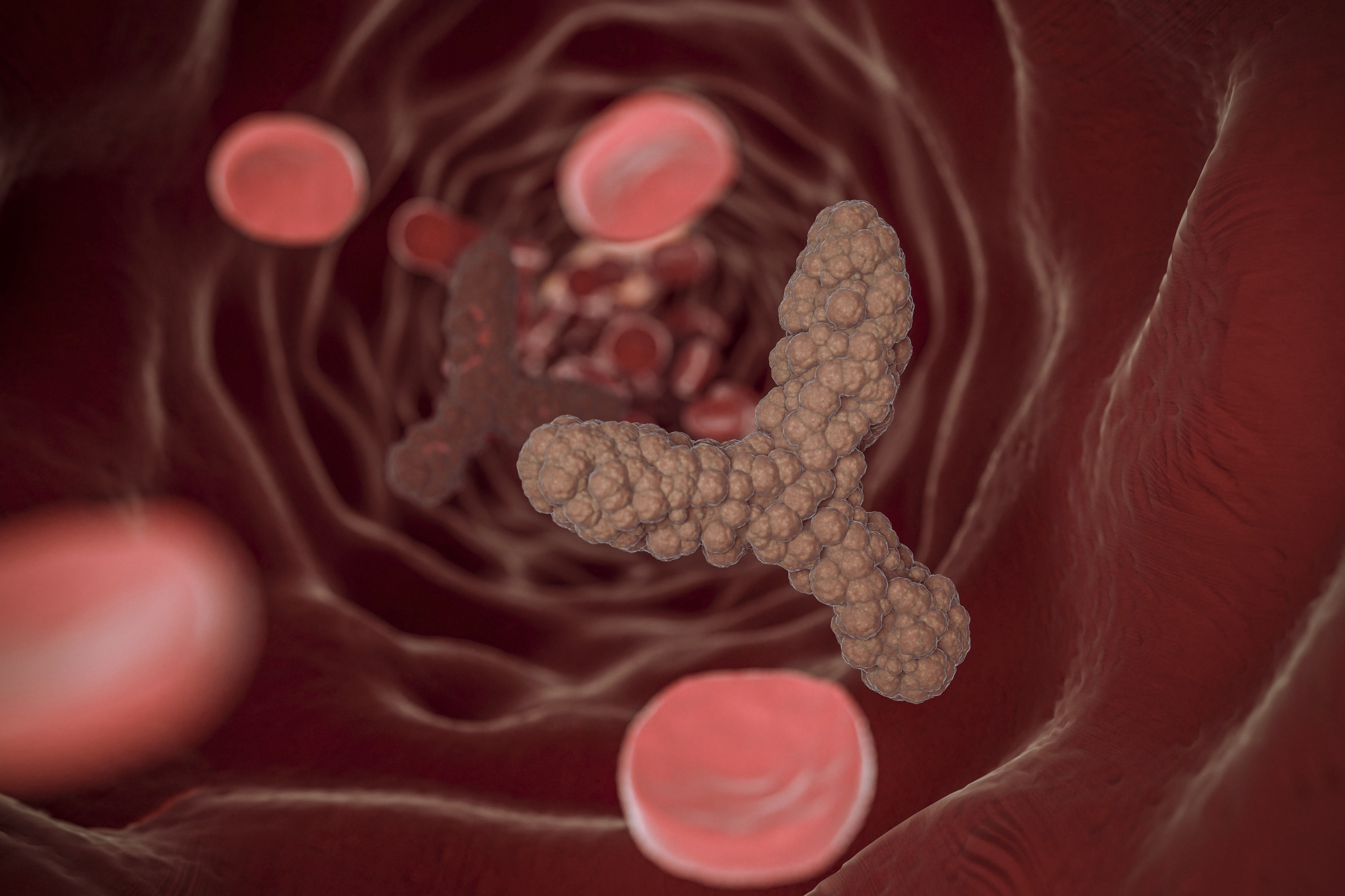 Colonic Polyps