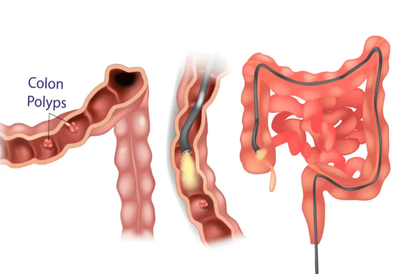Colonoscopy Services